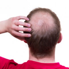 薄毛に悩む敏感肌やアトピーの人が使えるおすすめの育毛剤・育毛シャンプー