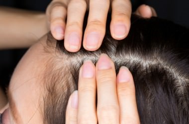 頭皮ニキビにニキビ用のスキンケア製品を使っても良い？　ヘアケア講座　頭皮ケア（スカルプケア）