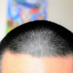 過度なヘアアレンジは抜け毛の原因に