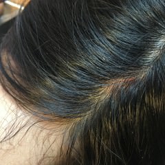 なかなか治らない頭皮かさぶたは治せるの 知らなきゃ損 正しいヘアケア講座