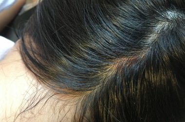 頭シラミとフケの見分け方 原因の違いと改善方法 知らなきゃ損 正しいヘアケア講座 頭シラミとフケの見分け方 原因の違いと改善方法 知らなきゃ損 正しいヘアケア講座