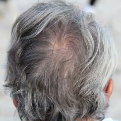 小麦粉を摂り過ぎると薄毛になる！？