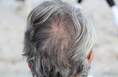 植毛でも育毛でもない！薄毛の最先端治療「ヘアクローニング」とは