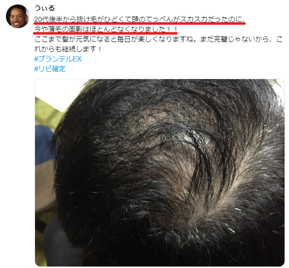ついに抜け毛に終止符 ようやく生えた と話題の画期的な発毛促進力を持つ薬用育毛剤がすごい 厚生労働省に認可 された実力は本物 知らなきゃ損 正しいヘアケア講座