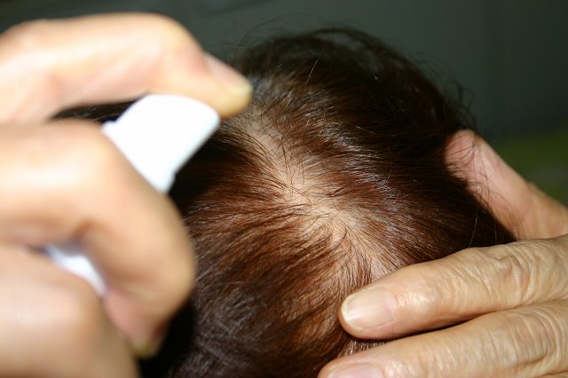 女性の薄毛の対処法は？おすすめの方法を徹底解説！