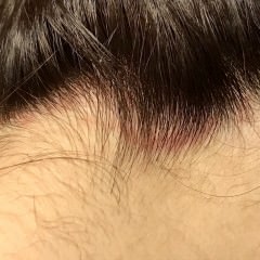 頭皮が赤いのはアレルギーが原因？