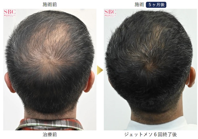 AGAの治療にオススメのクリニックはどこ？薄毛治療の費用や評判も徹底調査！40