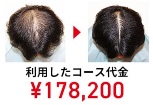 リーブ21  スカルプ　薄毛　抜け毛　脱毛　ハゲのケア