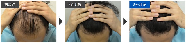 AGAの治療にオススメのクリニックはどこ？薄毛治療の費用や評判も徹底調査！13