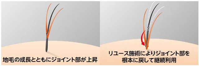 スヴェンソンの価格や料金体系は？かつらの値段や増毛の費用などを徹底調査しました！10