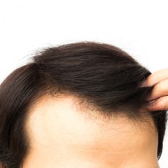 女性に多い薄毛の症状「びまん性脱毛症」とは？