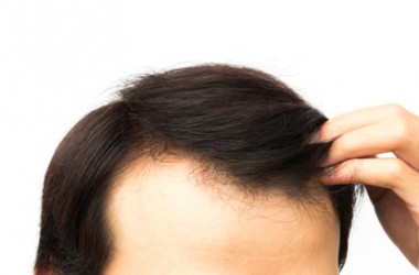 薄毛治療はメリットだけではない！薄毛治療の種類ごとにデメリットを解説します。　ヘアケア講座