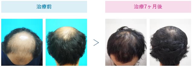 AGAの治療にオススメのクリニックはどこ？薄毛治療の費用や評判も徹底調査！8