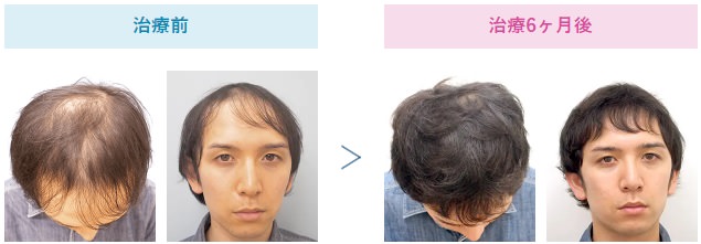 AGAの治療にオススメのクリニックはどこ？薄毛治療の費用や評判も徹底調査！7