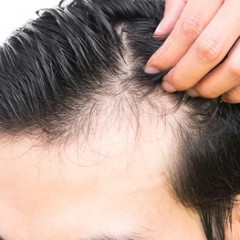 植毛した毛が抜ける…自毛植毛でも髪が抜ける原因とは？